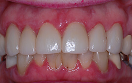 Healthy teeth and gums after dental treatment