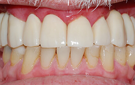 Healthy smile after dental restoration and tooth replacement