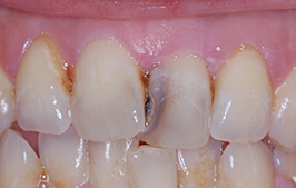 Severely discolored decayed and overlapping teeth
