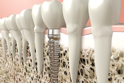 Animated dental smile with dental implant supported dental crown