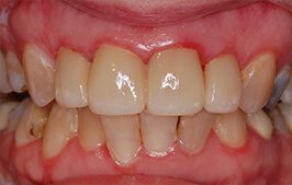 Healthy smile after dental restoration