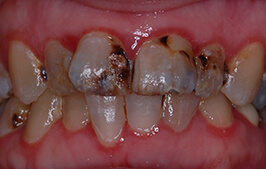 Severely decayed and damaged smile