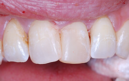 Healthy properly aligned smile after dental treatment