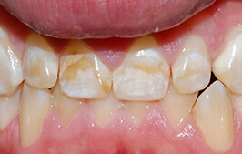 Discolored top front teeth