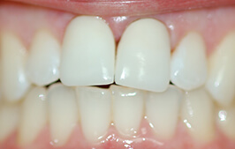 Flawless smile after front tooth is corrected
