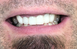 Healthy beautiful smile after dental restoration