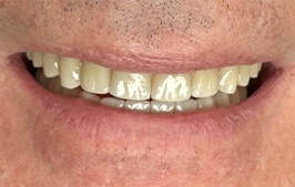 Healthy smile after dental restoration