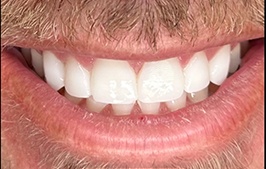 Healthy smile after dental restoration