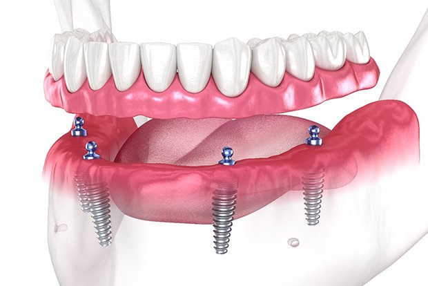 3D graphic of all-on-4 dental implants 