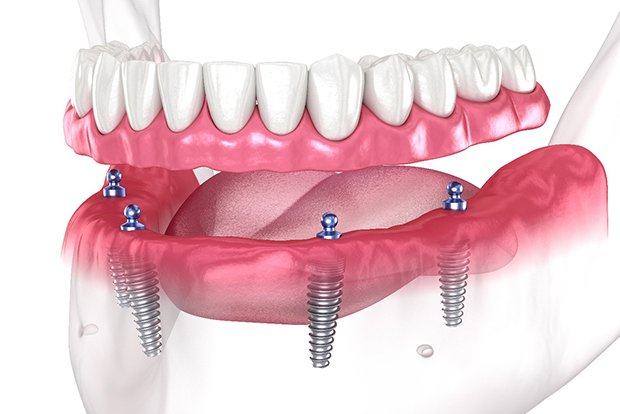 3D graphic of all-on-4 dental implants