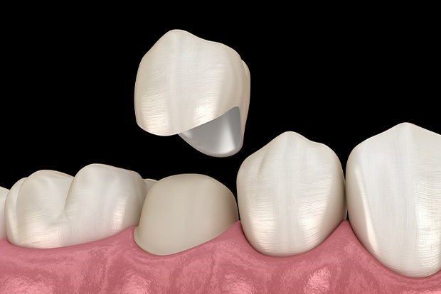Animated smile during metal free dental crown restoration