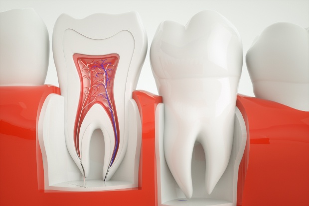 Animated smile before root canal therapy