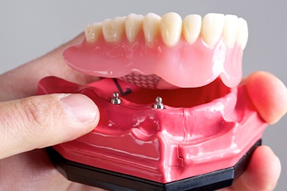 Model dental implant supported denture