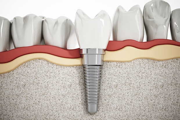 Animated smile with dental implant supported dental crown