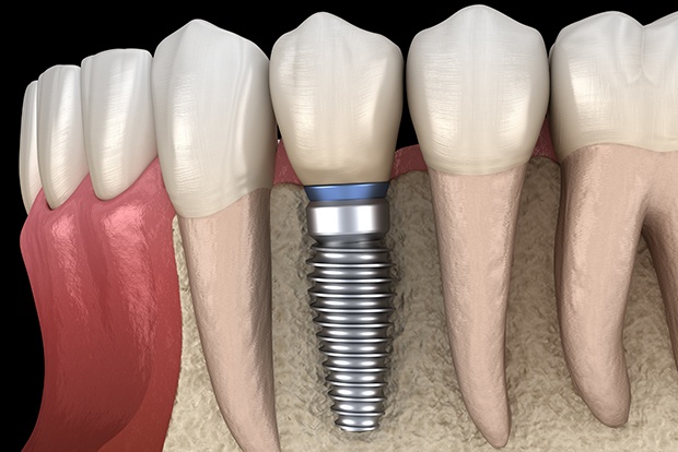 Animated smile with dental implant supported dental crown