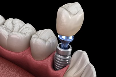 Animated smile during dental implant supported dental crown placement