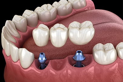 Animated smile during dental implant supported fixed bridge placement