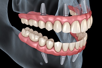 Animated smile with dental implant supported denture