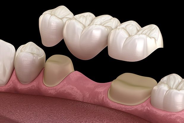 Animated smile during dental bridge placement