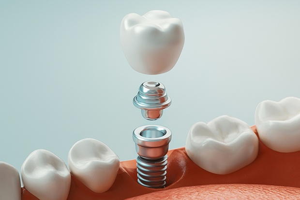 Animated smile during dental implant placement