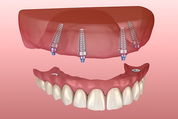 Animated dental implant denture placement