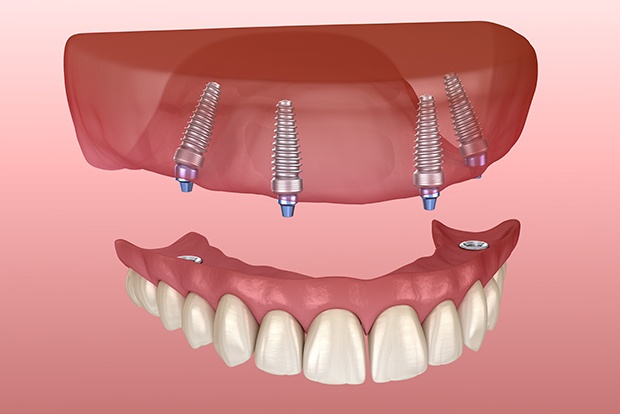 Animated dental implant denture placement