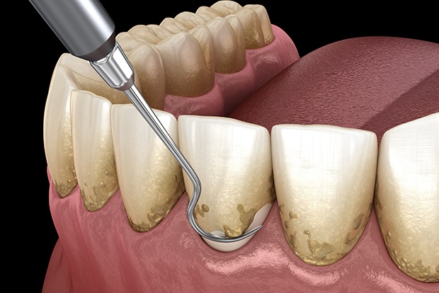 Animated smile during scaling and root planing treatment