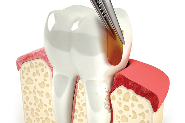 Animated smile during periochip antibiotic therpay