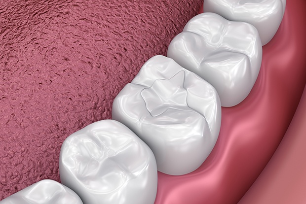 Animated smile with tooth colored filling restoration