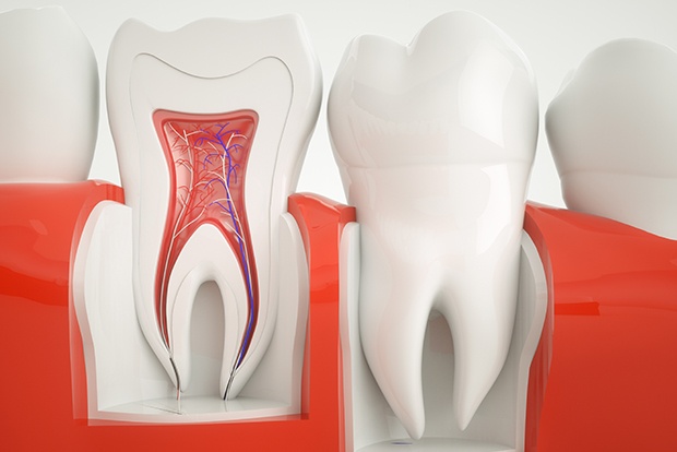 Animated tooth before root canal therapy