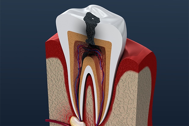 Animated tooth with decay in need of root canal therapy