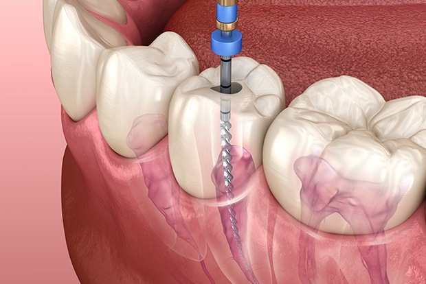 Animated smile during root canal therapy