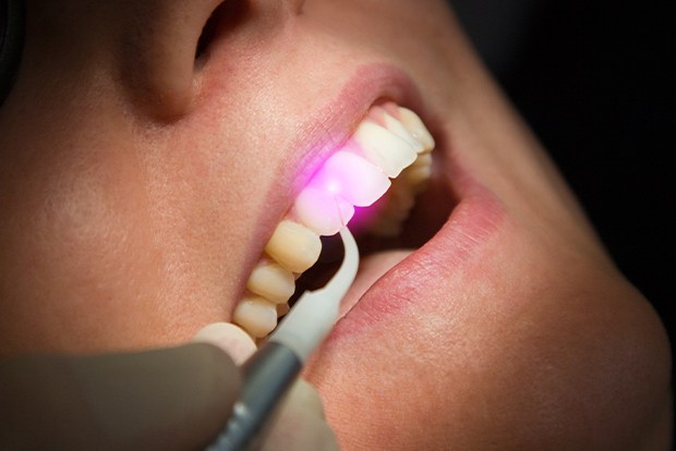 Patient receiving soft tissue laser dentistry treatment