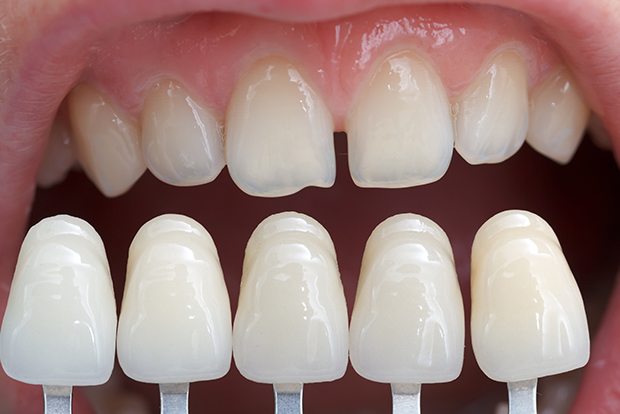 Smile compared with porcelain veneer shade chart
