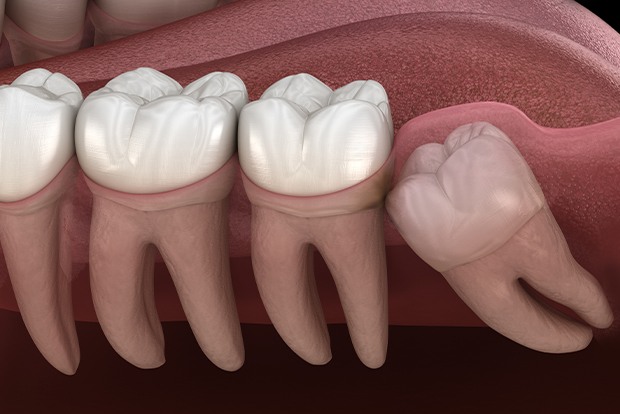 Animated smile with an impacted wisdom tooth