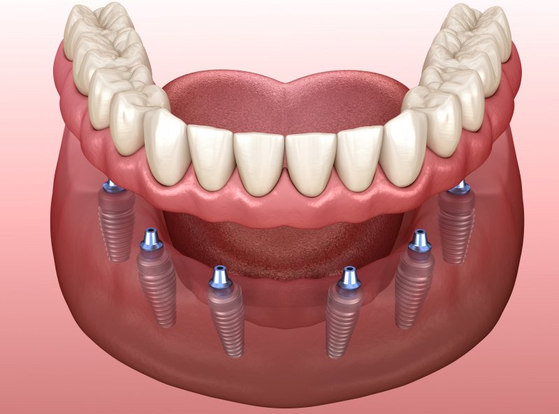 Dental implant dentures