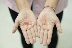 a person holding a broken denture in their hands