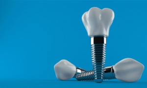 a closeup of dental implants